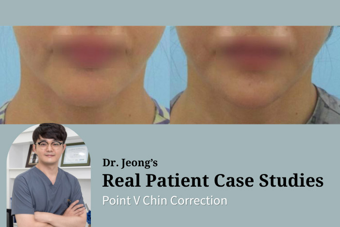 Point V Chin Correction — Non-Surgical Thread Chin Contouring