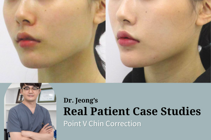 Point V Chin Correction — Non-Surgical Thread-Based V-Line Chin Contouring for a Slimmer, More Symmetrical Chin